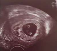 Sckock Beim Ersten Ultraschall Eineiige Zwillinge Wir Erwarten Baby Nummer 6 7 Urbia De
