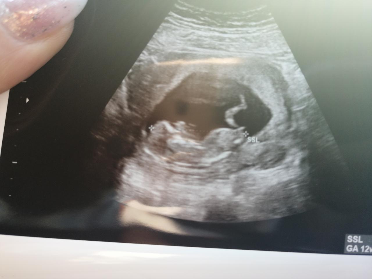 Фото ребенка 13 недель. Эмбрион на 13 неделе беременности.