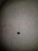 Punkt leberfleck schwarzer auf Schwarzer Hautkrebs: