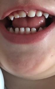 Grau verfärbt zahn Toter Zahn
