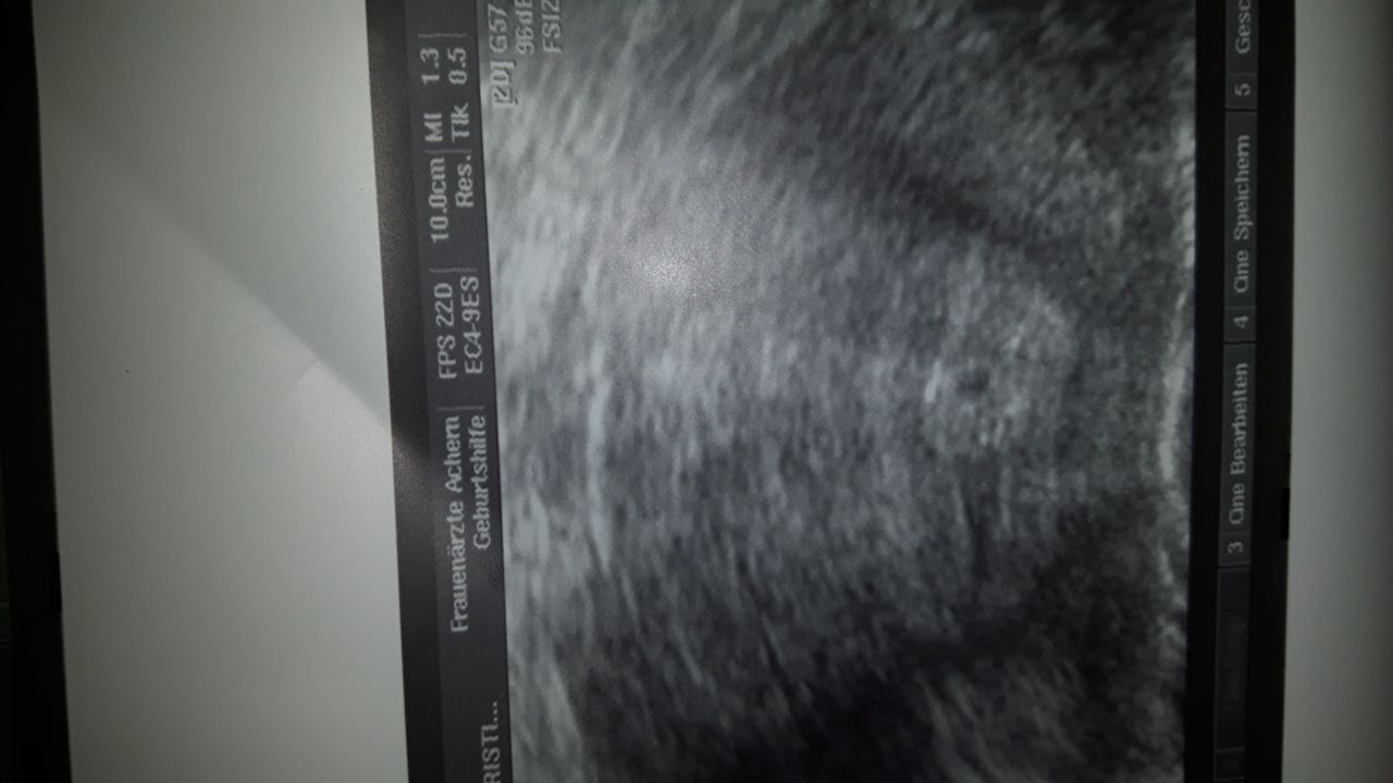 44 HQ Photos Wann Sieht Man Bei Einem Embryo Den Herzschlag - Wie hoch ist das Risiko für eine Fehlgeburt in den ersten ...