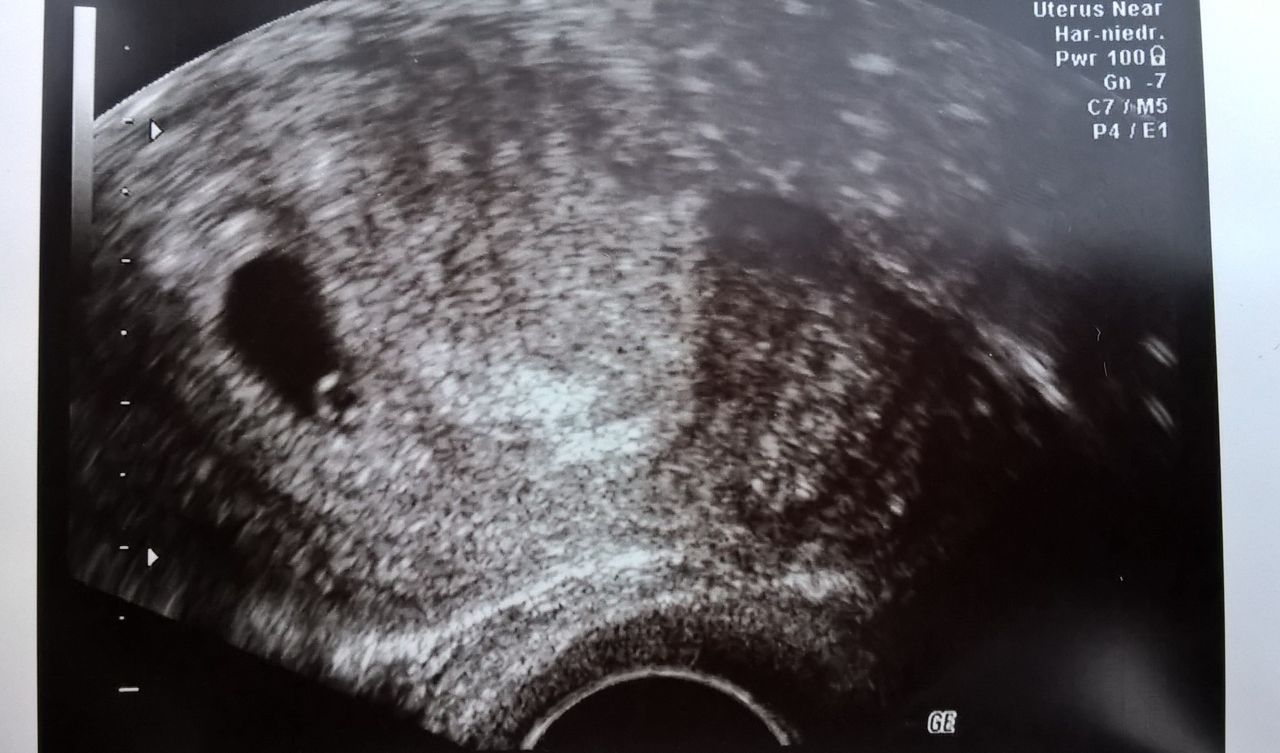 Ultraschall Schwangerschaft 5woche Zwillinge - Perry Platyphus 